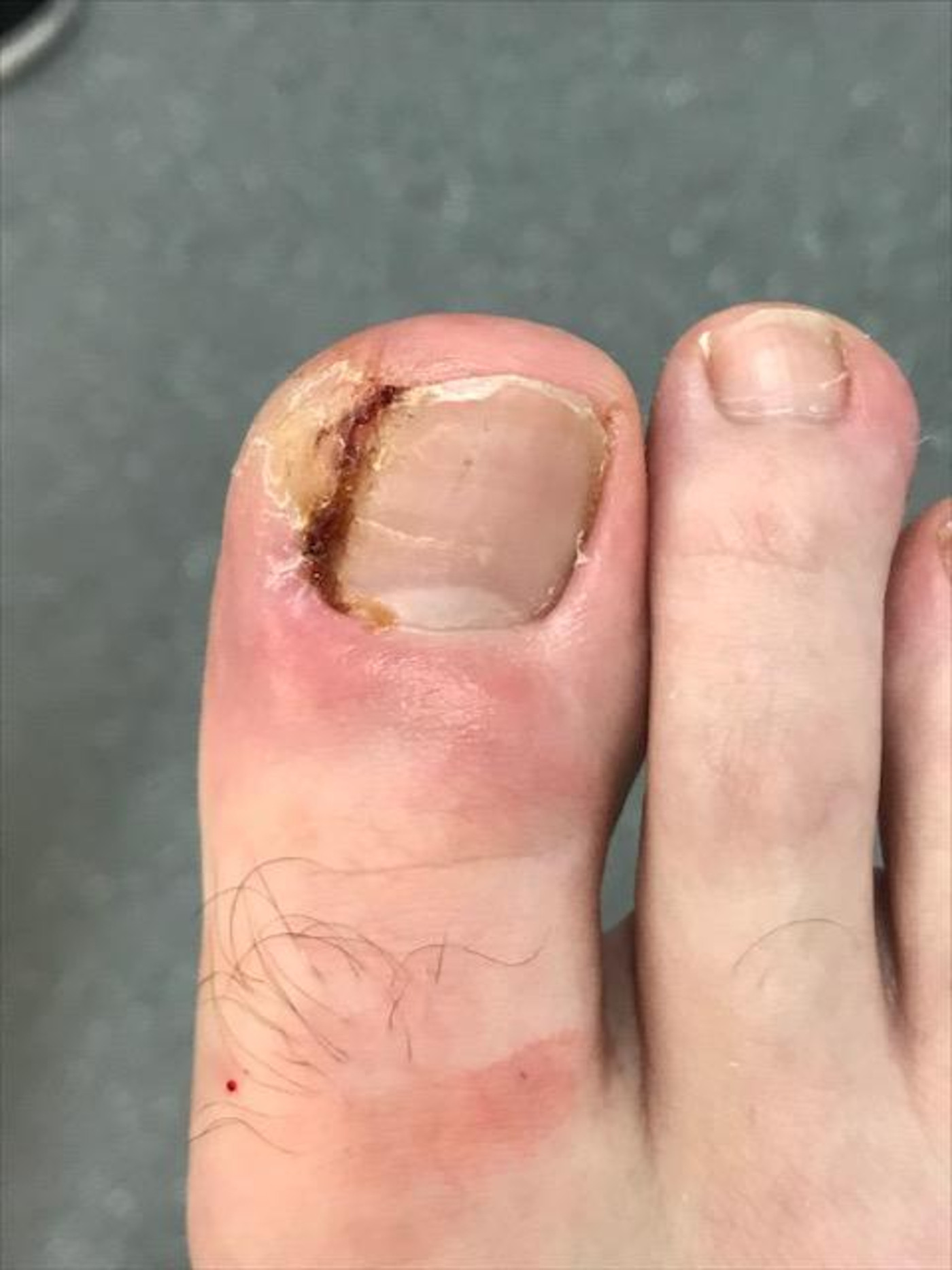 Ingrown Toenail Surgery - The Feet People