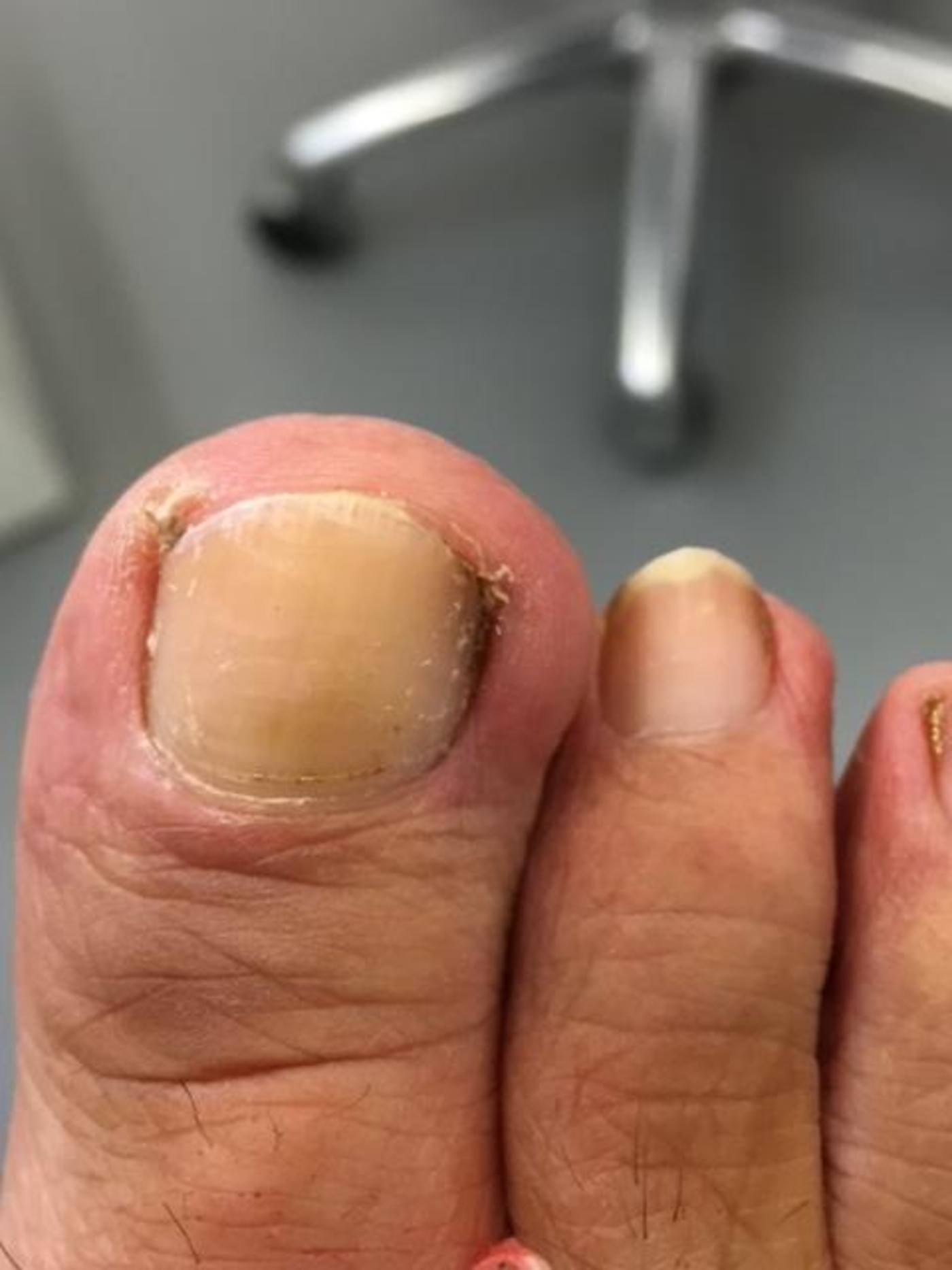 Surgical Treatments — Mackay Ingrown Toenail Clinic